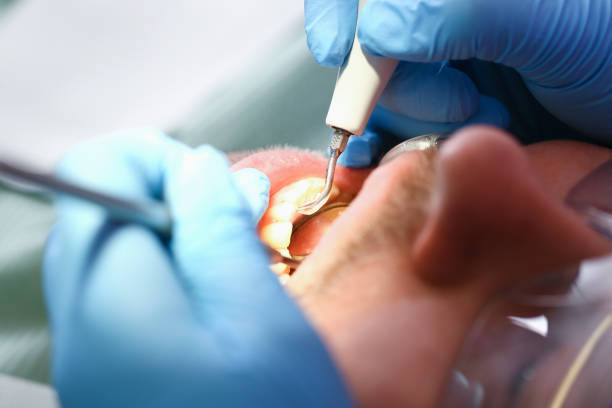 Best Broken or Cracked Tooth Emergency Dentist in Snohomish, WA