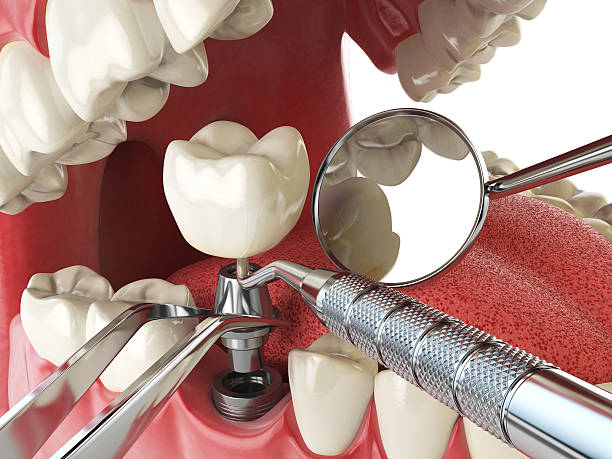 Best Emergency Dentist for Lost Fillings or Crowns in Snohomish, WA